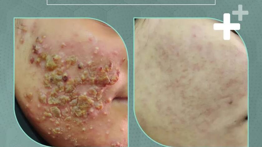 Acne Scar Treatment in Bhiwadi