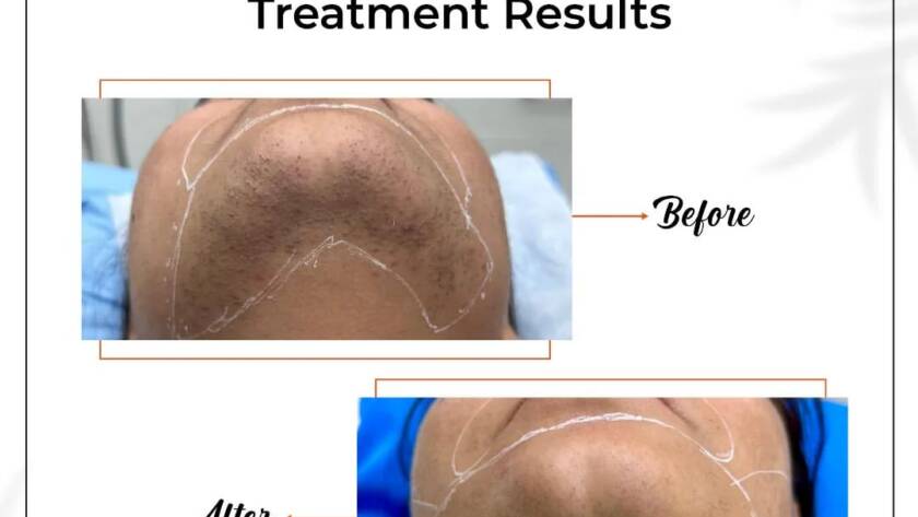 Laser Hair Removal in Bhiwadi