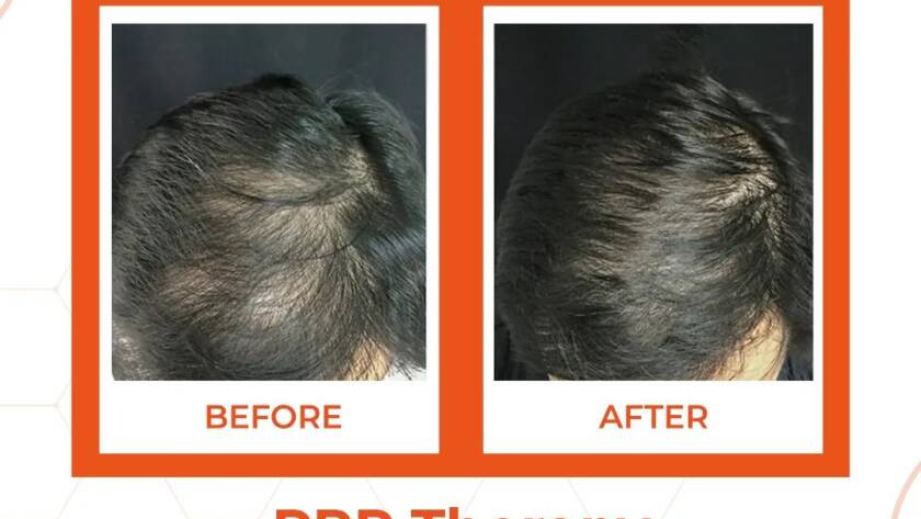 Best Hair Treatment Clinics in Bhiwadi