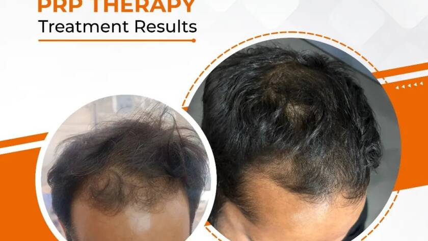 Best PRP Therapy Clinic in Bhiwadi