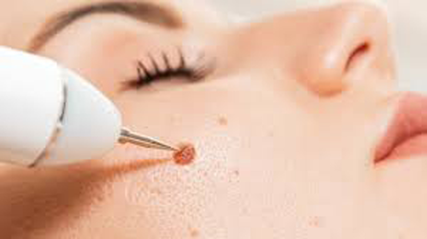 Laser Mole Removal Treatment in Bhiwadi