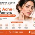 Adult Acne in Women: Why it Happens After 30 and How to Treat It?